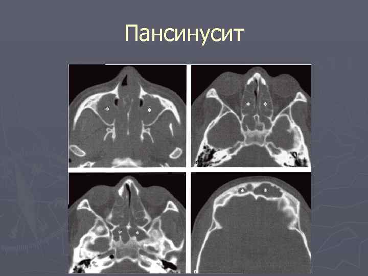 Пансинусит 