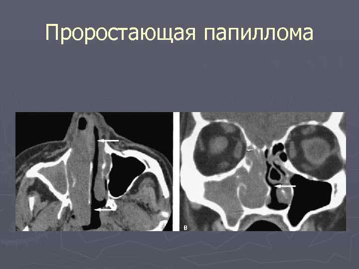 Проростающая папиллома 