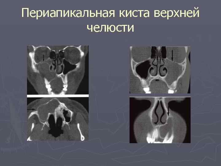 Периапикальная киста верхней челюсти 