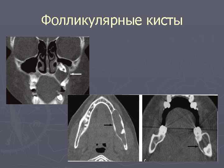 Фолликулярные кисты 