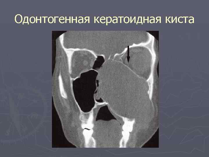 Одонтогенная кератоидная киста 