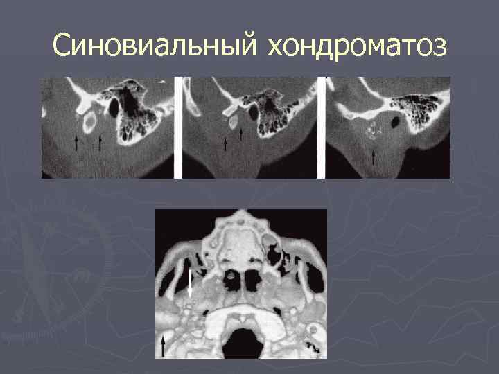 Синовиальный хондроматоз 