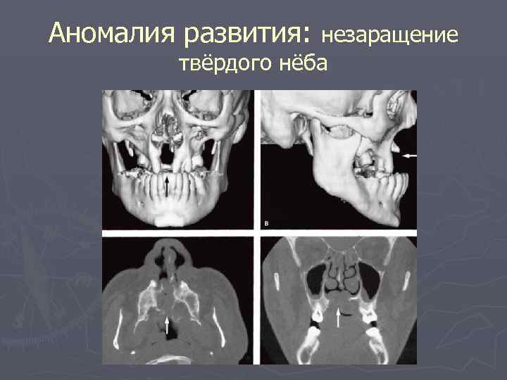 Аномалия развития: незаращение твёрдого нёба 