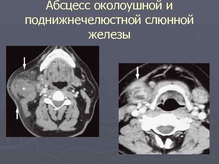  Абсцесс околоушной и поднижнечелюстной слюнной железы 