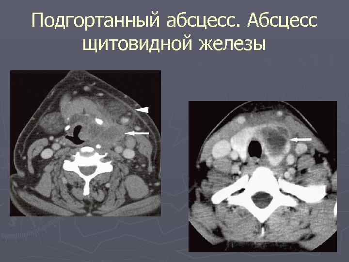 Подгортанный абсцесс. Абсцесс щитовидной железы 