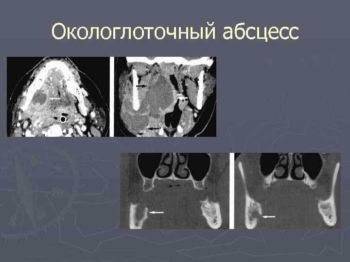 Окологлоточный абсцесс 