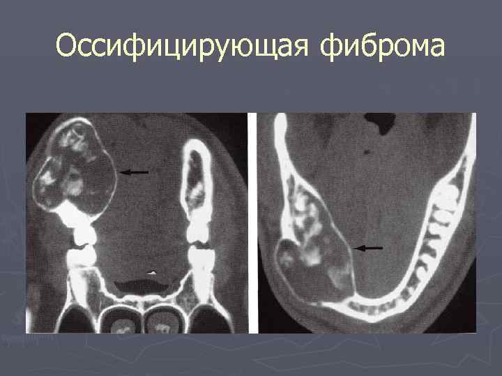 Оссифицирующая фиброма 