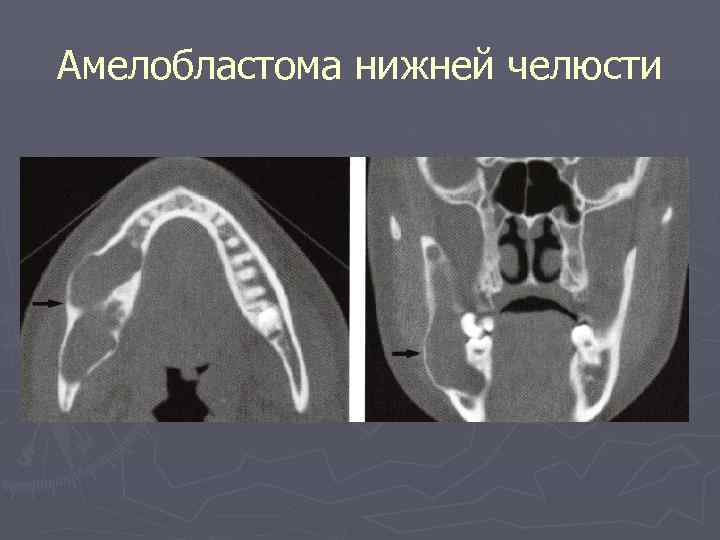 Амелобластома нижней челюсти 