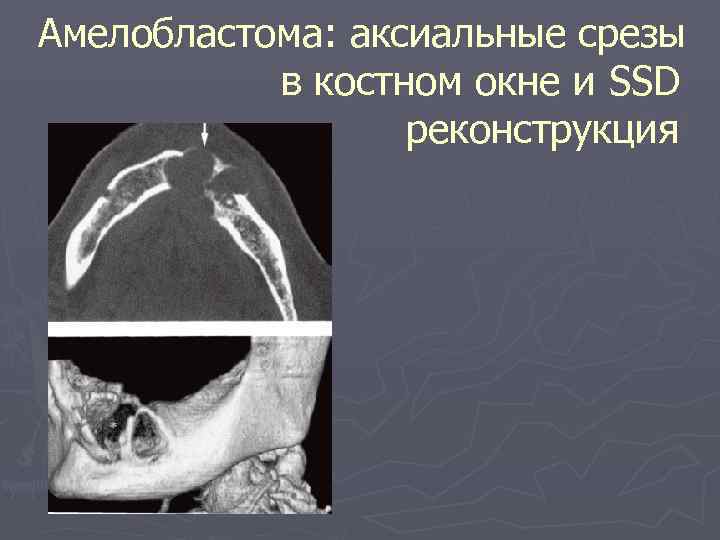 Амелобластома: аксиальные срезы в костном окне и SSD реконструкция 