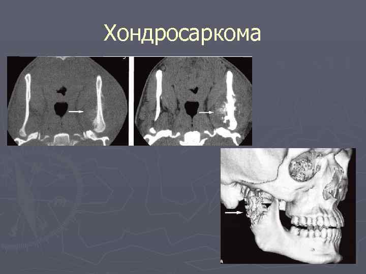 Хондросаркома 