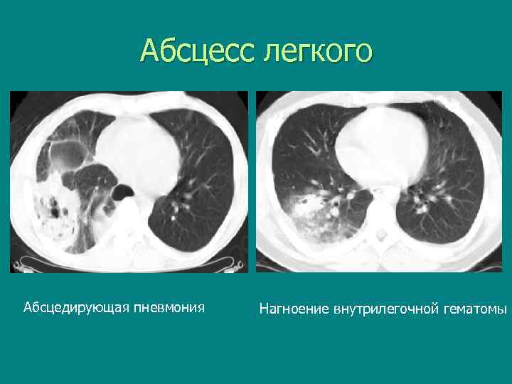  Абсцесс легкого Абсцедирующая пневмония Нагноение внутрилегочной гематомы 