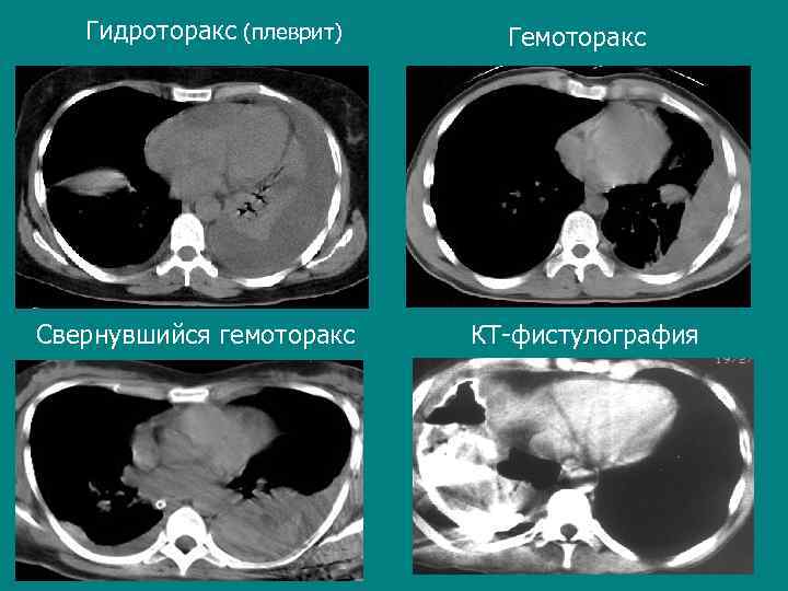  Гидроторакс (плеврит) Гемоторакс Свернувшийся гемоторакс КТ-фистулография 