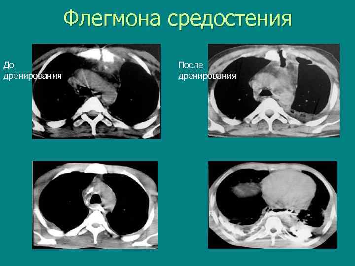  Флегмона средостения До После дренирования 