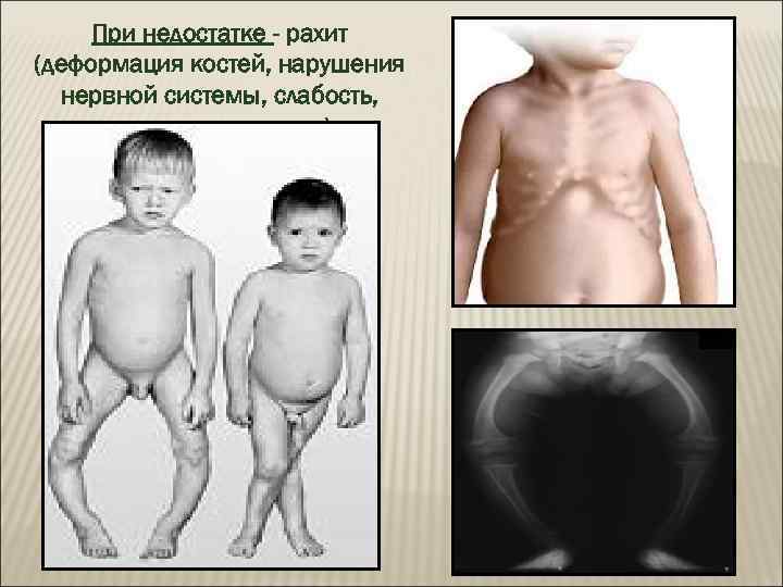  При недостатке - рахит (деформация костей, нарушения  нервной системы, слабость,  раздражительность)