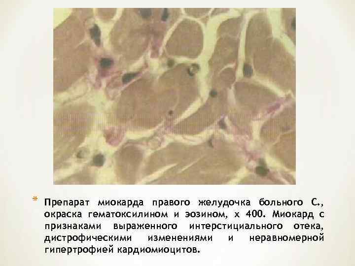 *  Препарат миокарда правого желудочка больного С. , окраска гематоксилином и эозином, х