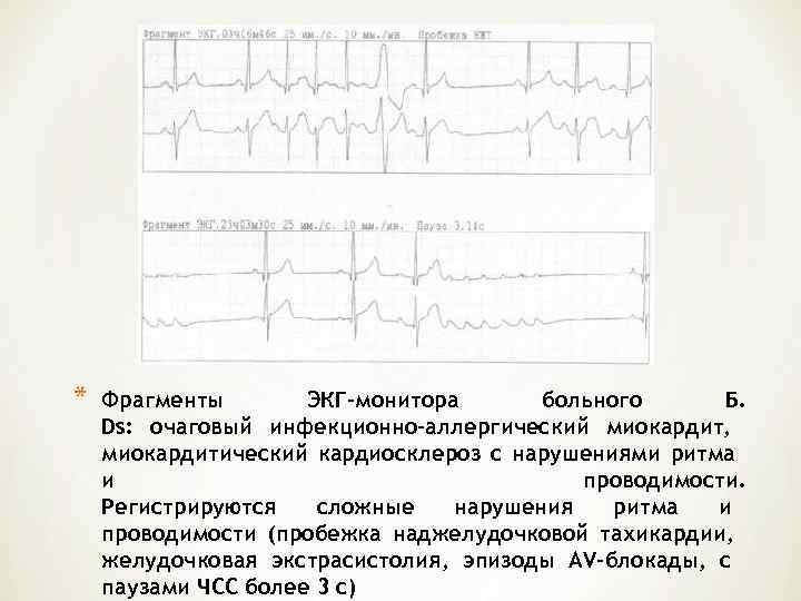 *  Фрагменты  ЭКГ–монитора  больного Б. Ds: очаговый инфекционно-аллергический миокардит, миокардитический кардиосклероз