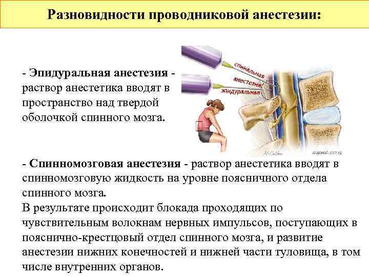   Разновидности проводниковой анестезии:  - Эпидуральная анестезия - раствор анестетика вводят в