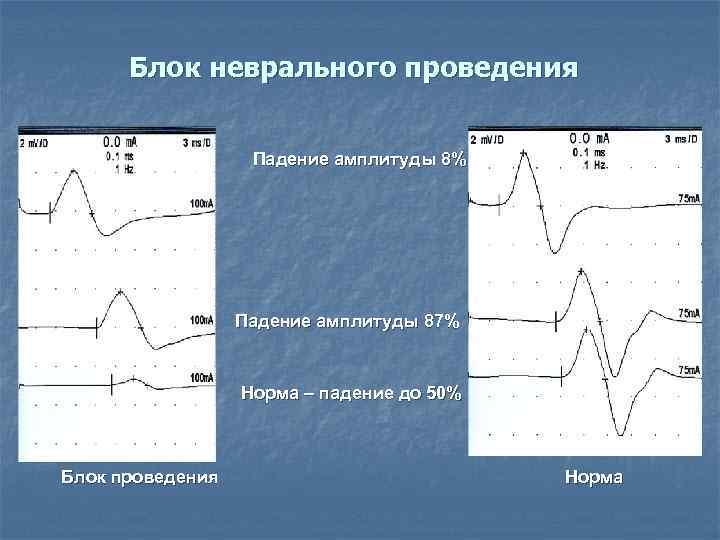  Блок неврального проведения     Падение амплитуды 8%   