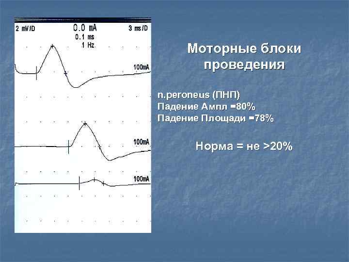 Моторные блоки  проведения n. peroneus (ПНП) Падение Ампл =80% Падение Площади =78%
