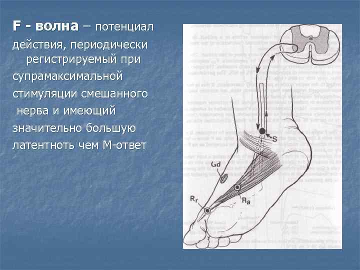 F - волна – потенциал действия, периодически  регистрируемый при супрамаксимальной стимуляции смешанного нерва