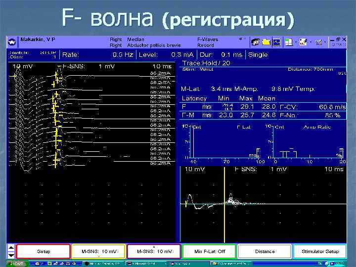 F- волна (регистрация) 