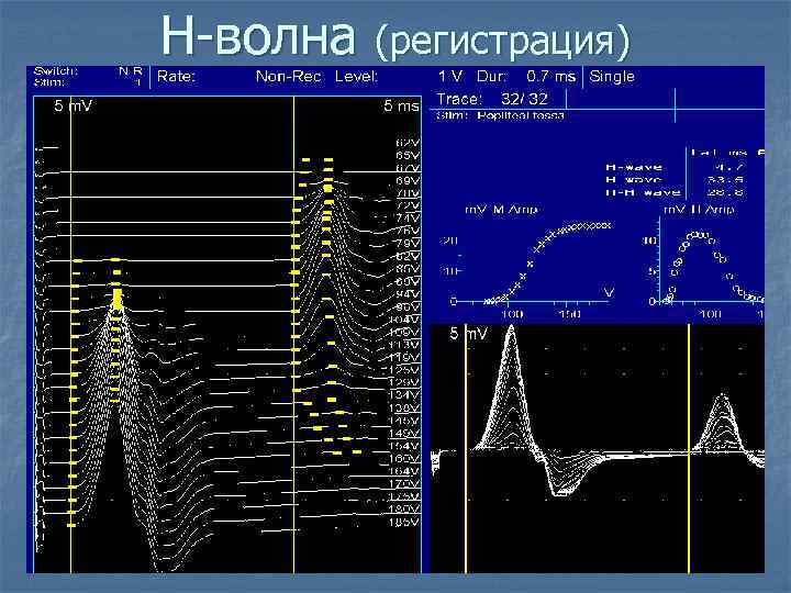 Н-волна (регистрация) 