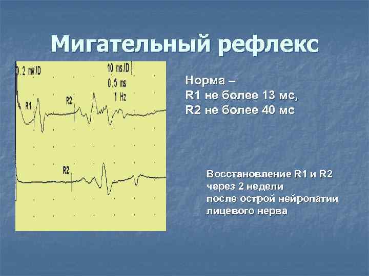 Мигательный рефлекс   Норма –   R 1 не более 13 мс,