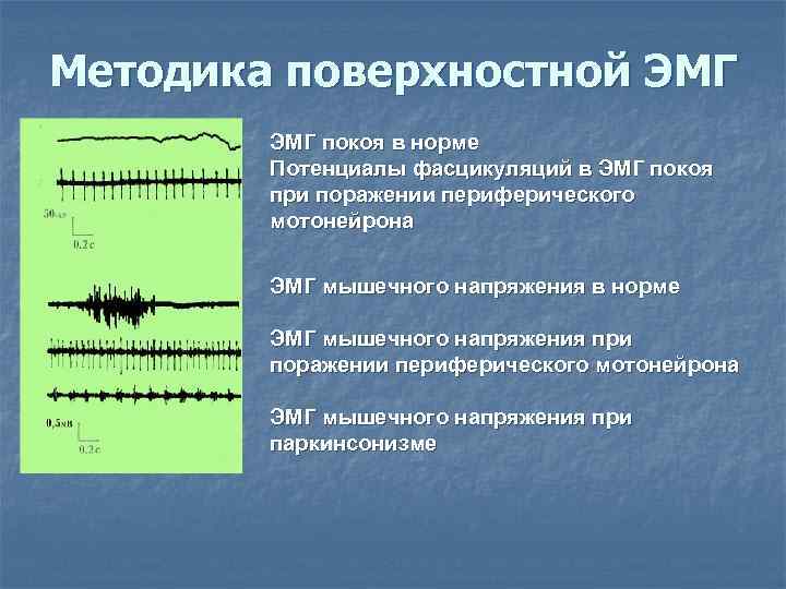 Методика поверхностной ЭМГ покоя в норме   Потенциалы фасцикуляций в ЭМГ покоя 