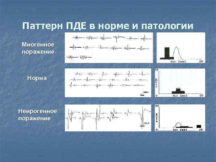  Паттерн ПДЕ в норме и патологии Миогенное поражение Норма Нейрогенное поражение 