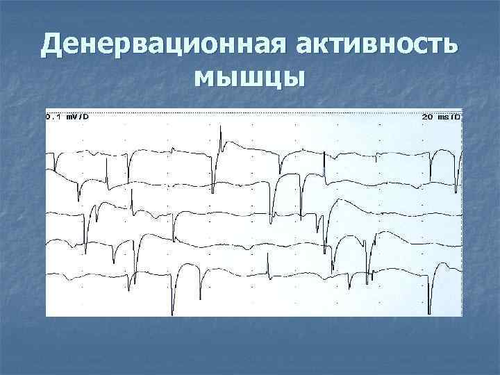 Денервационная активность   мышцы 