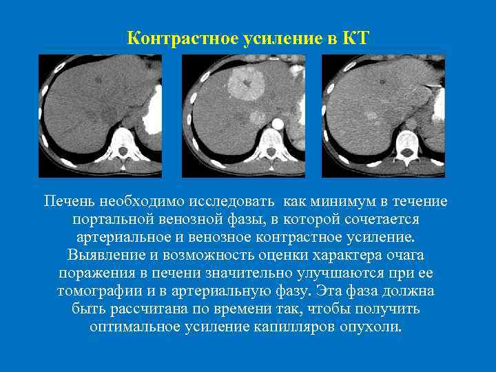  Контрастное усиление в КТ Печень необходимо исследовать как минимум в течение портальной венозной