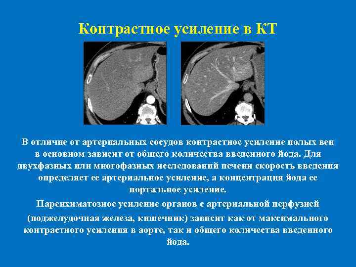  Контрастное усиление в КТ В отличие от артериальных сосудов контрастное усиление полых вен