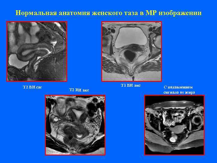 Нормальная анатомия женского таза в МР изображении  Т 2 ВИ саг  