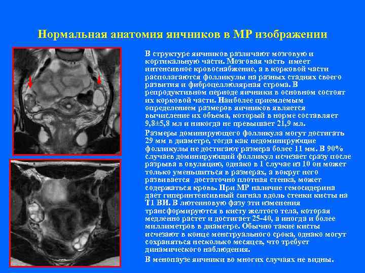 Нормальная анатомия яичников в МР изображении   В структуре яичников различают мозговую и