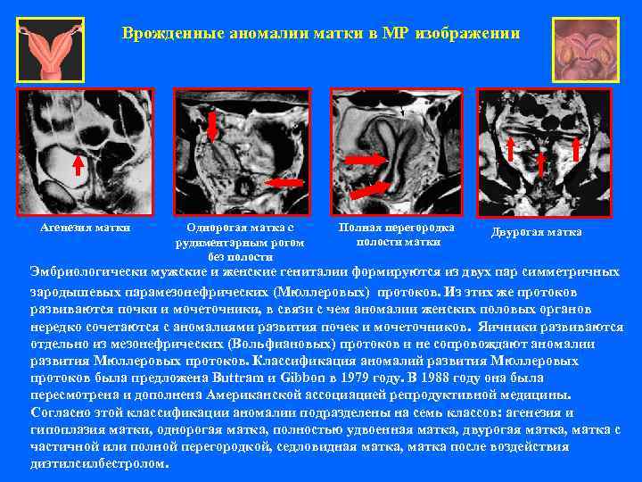    Врожденные аномалии матки в МР изображении Агенезия матки  Однорогая матка