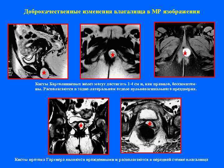   Доброкачественные изменения влагалища в МР изображении   Кисты Бартолиниевых желез могут