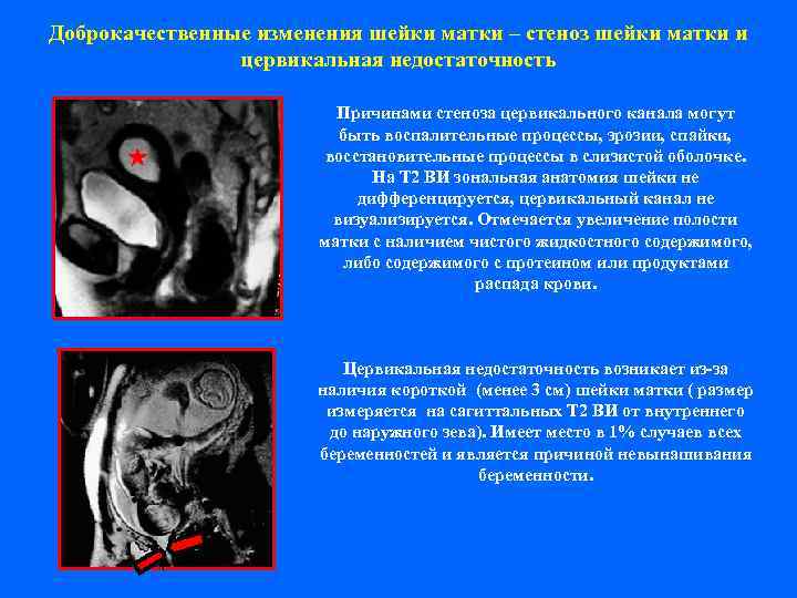Доброкачественные изменения шейки матки – стеноз шейки матки и   цервикальная недостаточность 