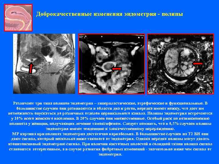    Доброкачественные изменения эндометрия - полипы  Различают три типа полипов эндометрия