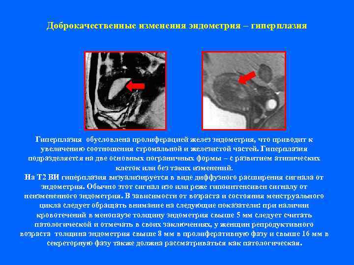  Доброкачественные изменения эндометрия – гиперплазия   Гиперплазия обусловлена пролиферацией желез эндометрия, что