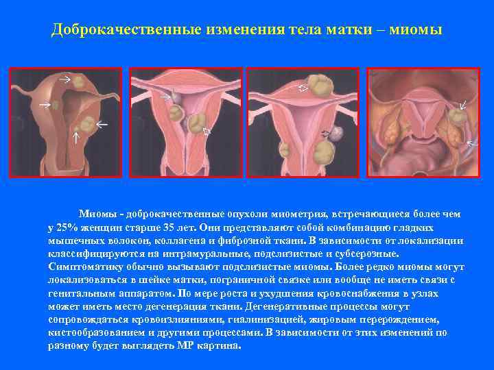 Доброкачественные изменения тела матки – миомы  Миомы - доброкачественные опухоли миометрия, встречающиеся более