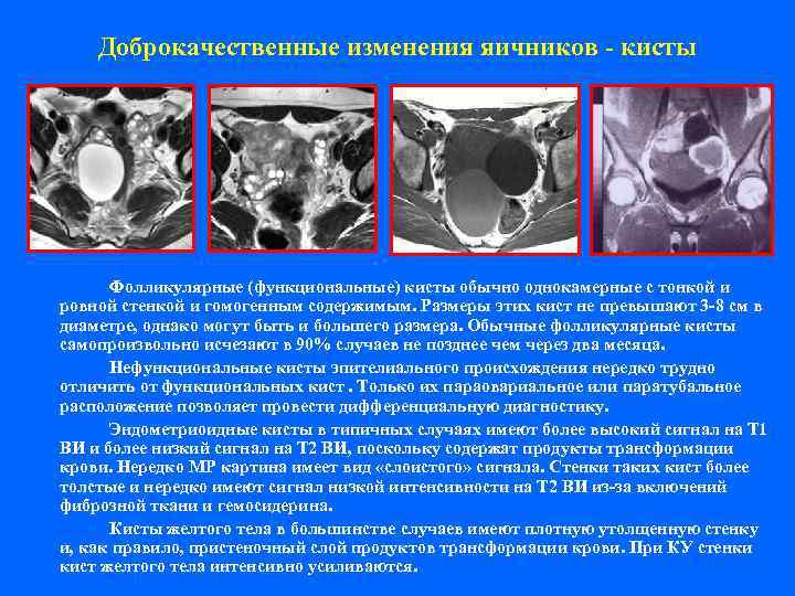   Доброкачественные изменения яичников - кисты  Фолликулярные (функциональные) кисты обычно однокамерные с