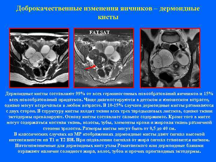  Доброкачественные изменения яичников – дермоидные      кисты  