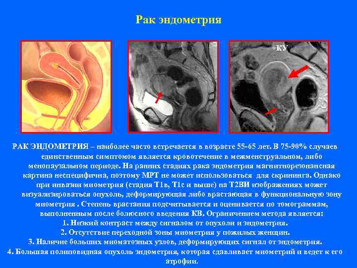       Рак эндометрия      