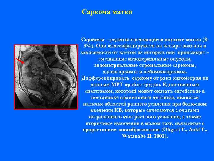 Саркома матки  Саркомы - редко встречающиеся опухоли матки (2 - 3%). Они классифицируются