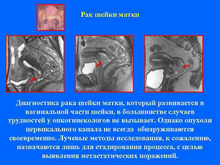     Рак шейки матки  Диагностика рака шейки матки, который развивается