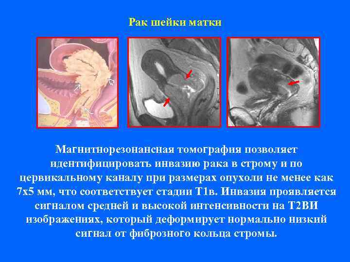     Рак шейки матки  Магнитнорезонансная томография позволяет  идентифицировать инвазию