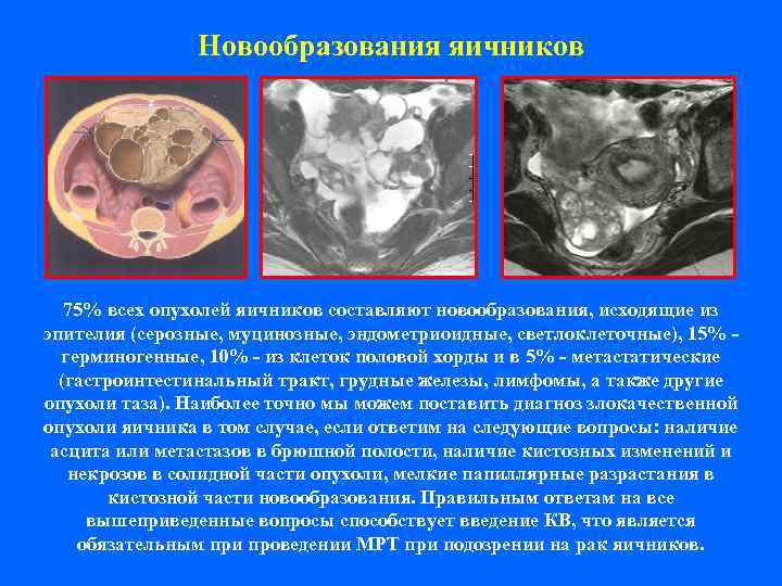     Новообразования яичников  75% всех опухолей яичников составляют новообразования, исходящие