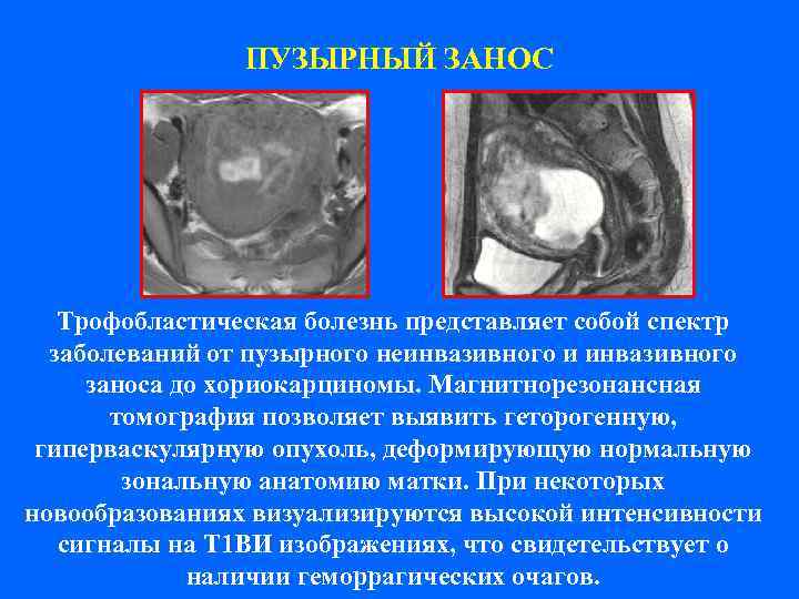     ПУЗЫРНЫЙ ЗАНОС  Трофобластическая болезнь представляет собой спектр  заболеваний
