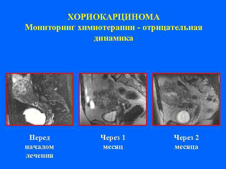   ХОРИОКАРЦИНОМА Мониторинг химиотерапии - отрицательная    динамика Перед  