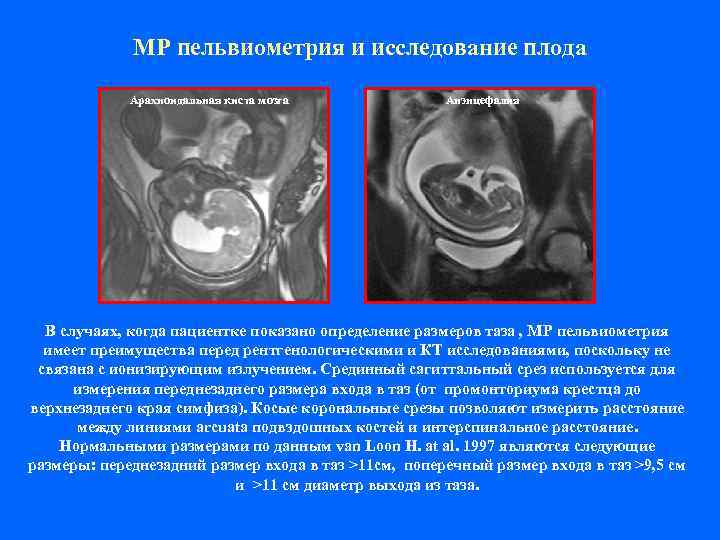    МР пельвиометрия и исследование плода    Арахноидальная киста мозга